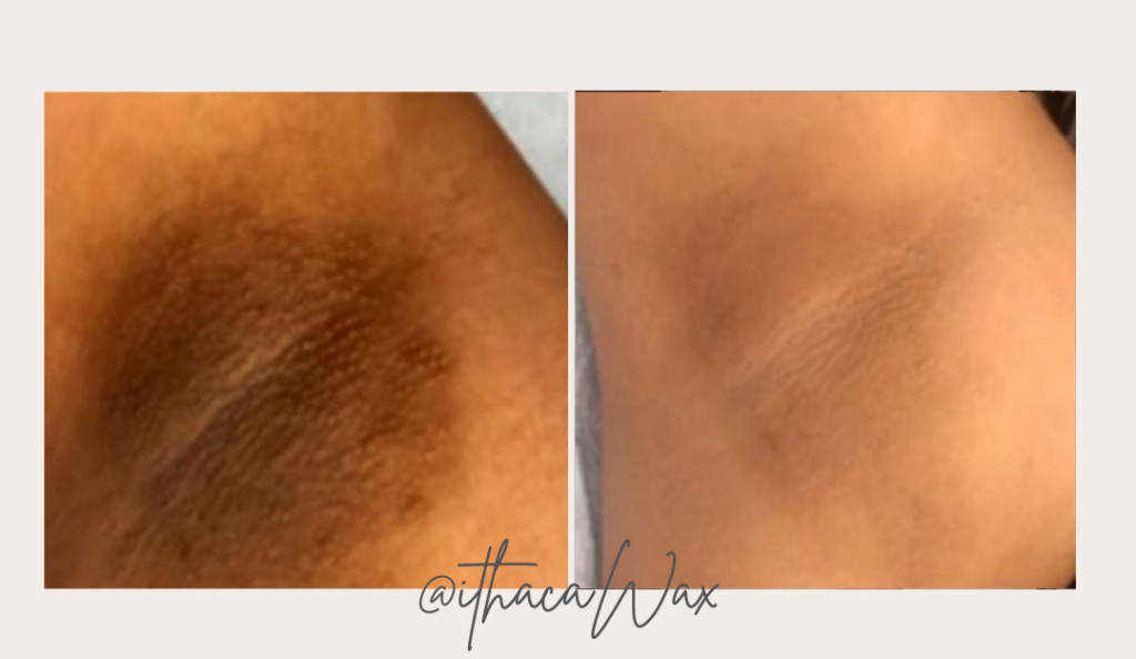 post inflammatory hyperpigmentation after waxing underarm before and after